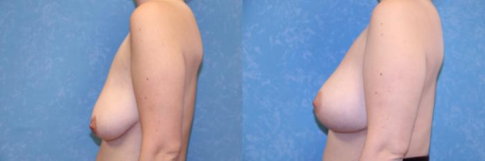 Before & After Breast Lift Case 493 Left Side View in Toledo, Ohio