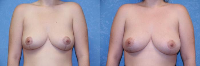 Before & After Breast Lift Case 493 One Year Scar Progress View in Toledo, Ohio