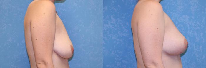 Before & After Breast Lift Case 493 Right Side View in Toledo, Ohio
