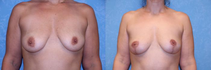 Before & After Breast Lift Case 504 Front View in Toledo, Ohio