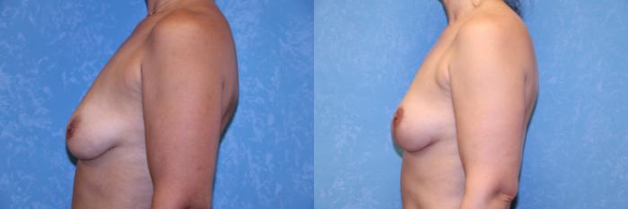 Before & After Breast Lift Case 504 Left Side View in Toledo, Ohio