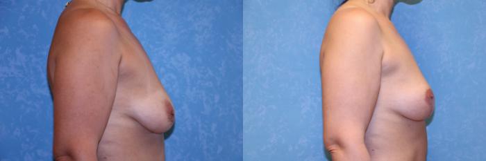 Before & After Breast Lift Case 504 Right Side View in Toledo, Ohio