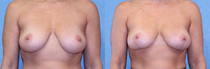 Before & After Breast Lift Case 505 Front View in Toledo, Ohio