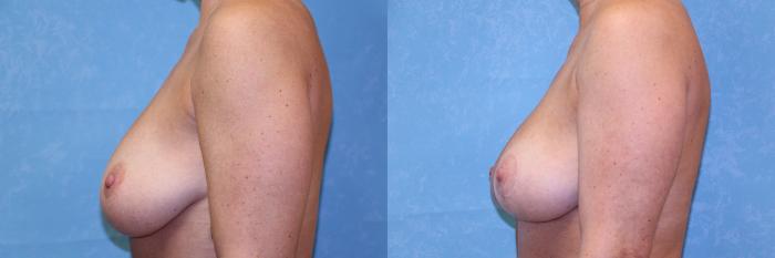 Before & After Breast Lift Case 505 Left Side View in Toledo, Ohio