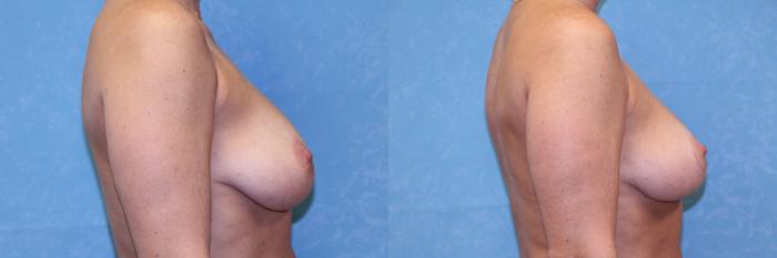 Before & After Breast Lift Case 505 Right Side View in Toledo, Ohio