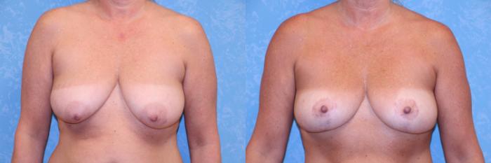Before & After Breast Lift Case 516 Front View in Toledo, Ohio