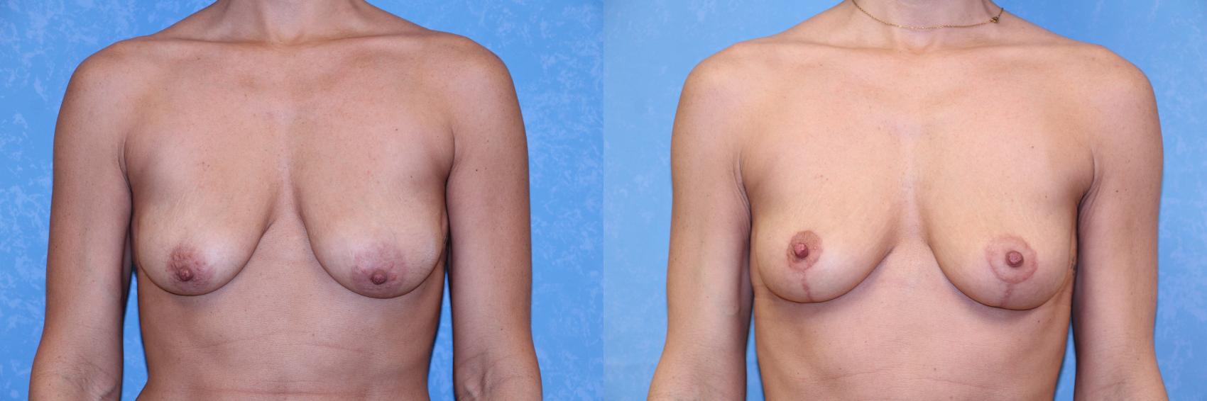 Before & After Breast Lift Case 572 Front View in Toledo, Ohio