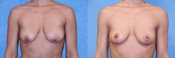 Before & After Breast Lift Case 572 Front View in Toledo, Ohio
