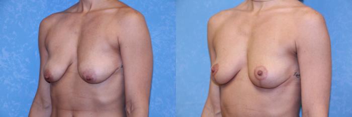 Before & After Breast Lift Case 572 Left Oblique View in Toledo, Ohio