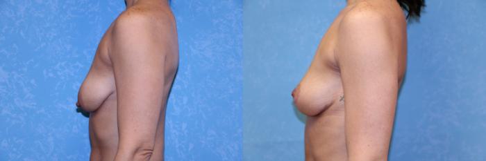 Before & After Breast Lift Case 572 Left Side View in Toledo, Ohio