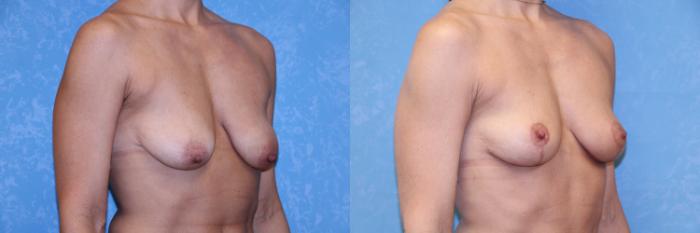 Before & After Breast Lift Case 572 Right Oblique View in Toledo, Ohio