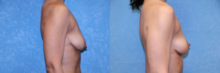 Before & After Breast Lift Case 572 Right Side View in Toledo, Ohio