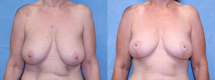 Before & After Breast Lift Case 580 Front View in Toledo, Ohio