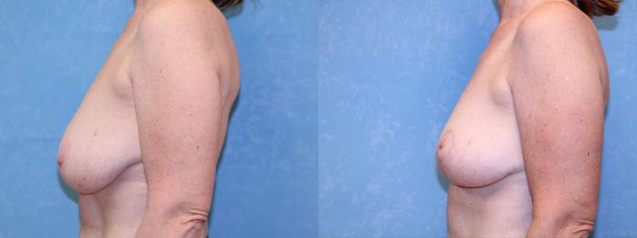 Before & After Breast Lift Case 580 Left Side View in Toledo, Ohio