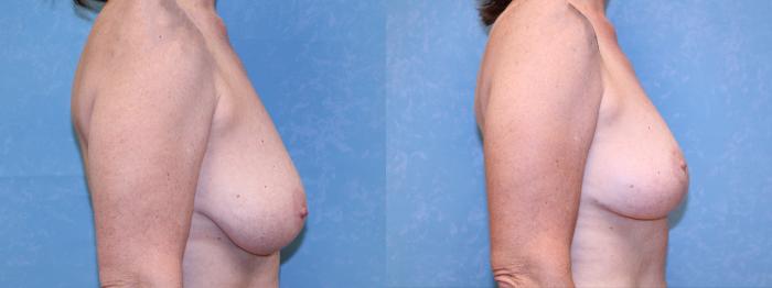 Before & After Breast Lift Case 580 Right Side View in Toledo, Ohio