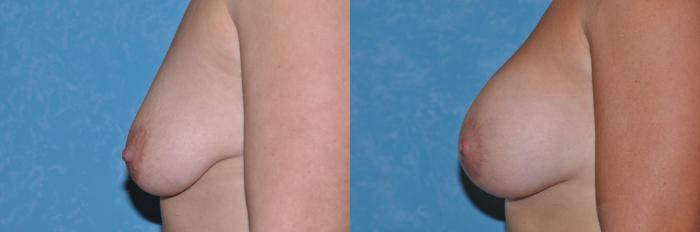 Before & After Breast Lift With Implants Case 13 Left Side View in Toledo, Ohio