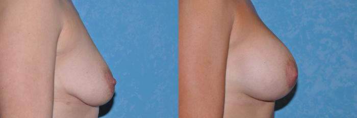 Before & After Breast Lift With Implants Case 13 Right Side View in Toledo, Ohio