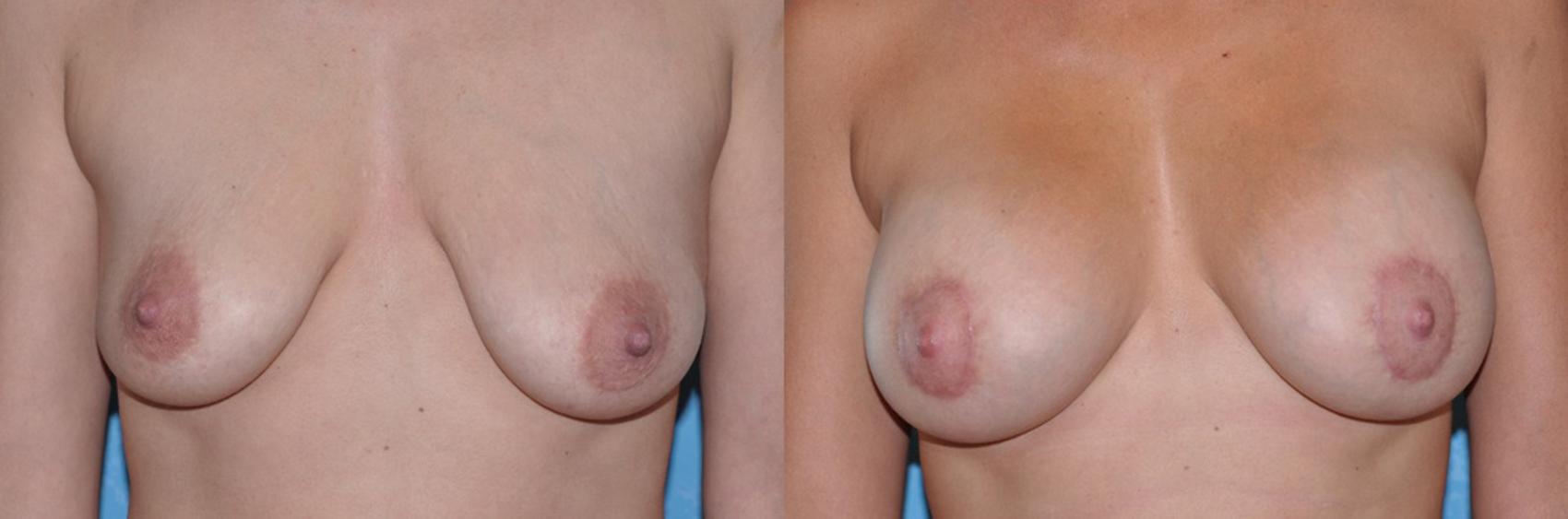 Before & After Breast Lift With Implants Case 13 View #1 View in Toledo, Ohio
