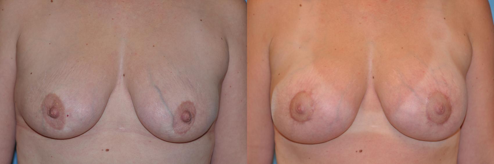 Before & After Breast Lift With Implants Case 143 View #1 View in Toledo, Ohio