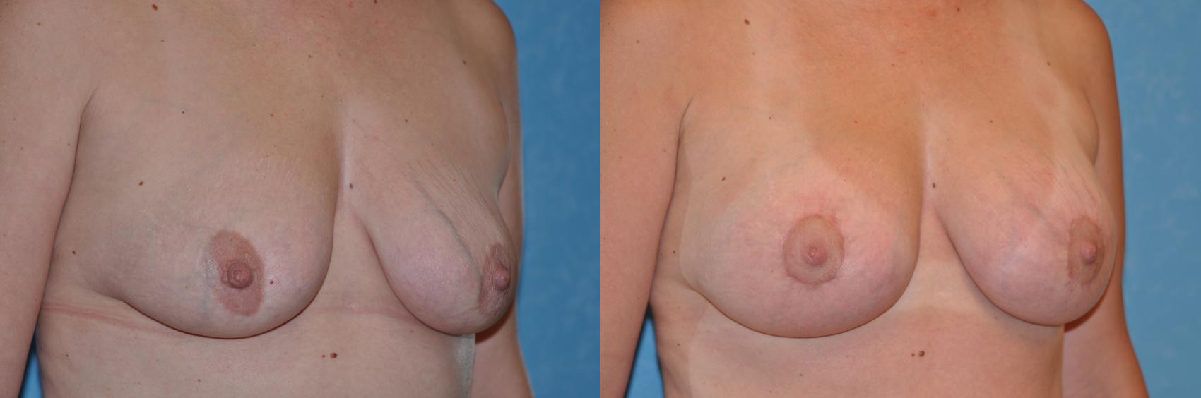 Before & After Breast Lift With Implants Case 143 View #2 View in Toledo, Ohio