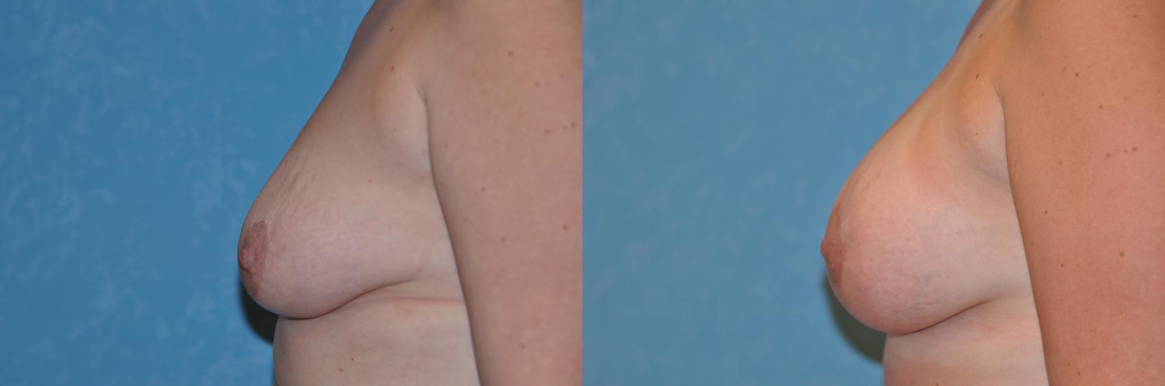 Before & After Breast Lift With Implants Case 143 View #3 View in Toledo, Ohio