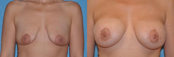 Before & After Breast Lift With Implants Case 147 View #1 View in Toledo, Ohio