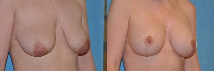 Before & After Breast Lift With Implants Case 149 View #1 View in Toledo, Ohio