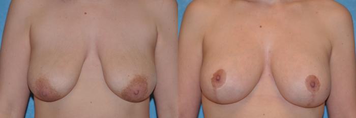 Before & After Breast Lift With Implants Case 149 View #2 View in Toledo, Ohio