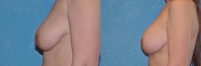 Before & After Breast Lift With Implants Case 149 View #3 View in Toledo, Ohio