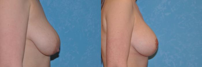 Before & After Breast Lift With Implants Case 149 View #4 View in Toledo, Ohio