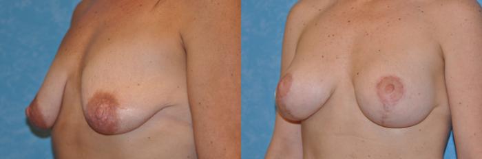 Before & After Breast Lift With Implants Case 186 View #3 View in Toledo, Ohio