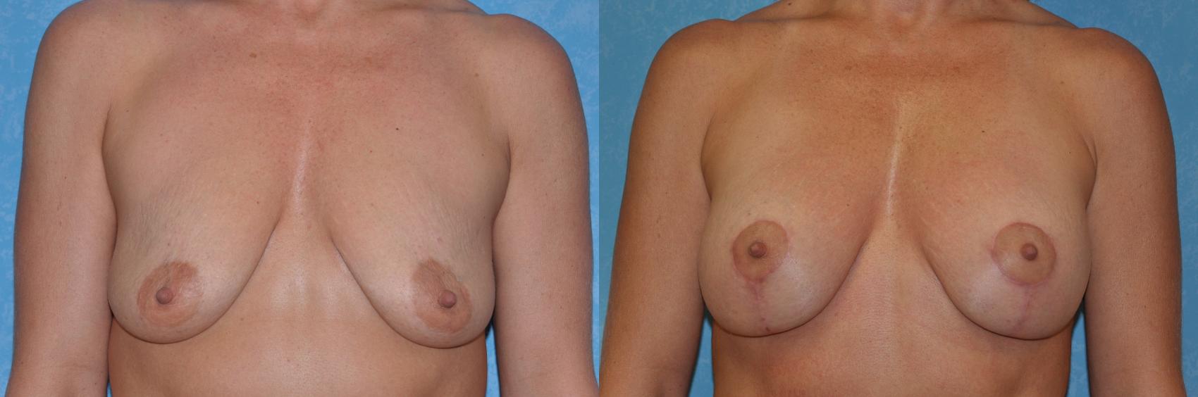 Before & After Breast Lift With Implants Case 214 View #1 View in Toledo, Ohio