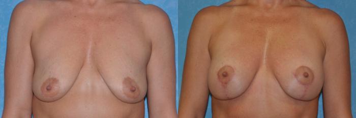 Before & After Breast Lift With Implants Case 214 View #1 View in Toledo, Ohio