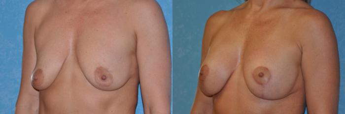 Before & After Breast Lift With Implants Case 214 View #3 View in Toledo, Ohio
