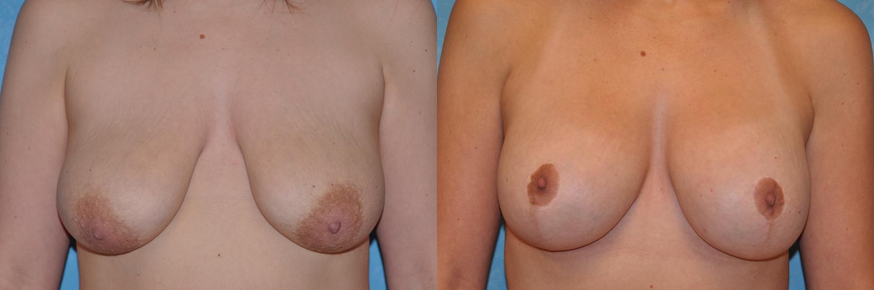 Before & After Breast Lift With Implants Case 215 View #1 View in Toledo, Ohio