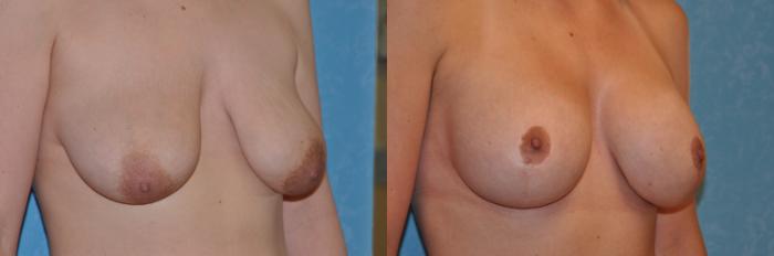 Before & After Breast Lift With Implants Case 215 View #3 View in Toledo, Ohio