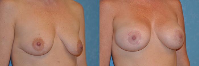 Before & After Breast Lift With Implants Case 218 View #2 View in Toledo, Ohio
