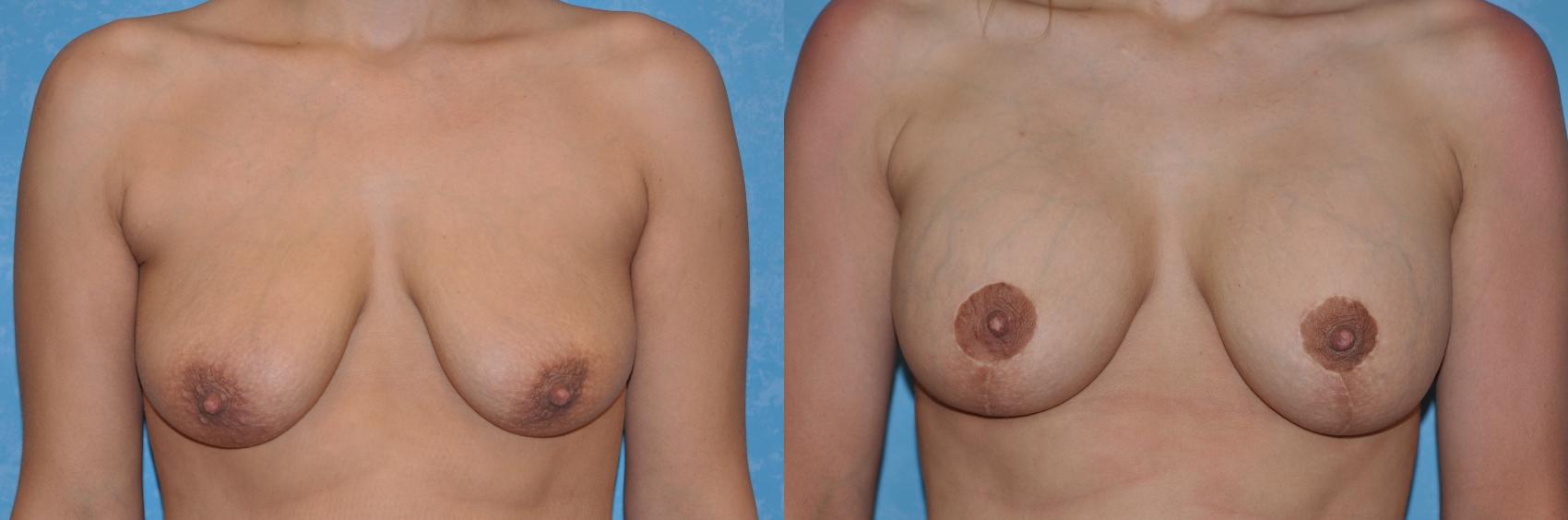 Before & After Breast Lift With Implants Case 219 View #1 View in Toledo, Ohio