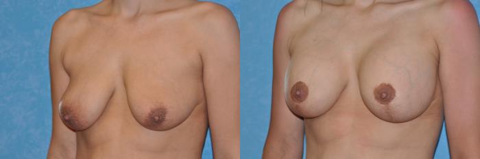 Before & After Breast Lift With Implants Case 219 View #2 View in Toledo, Ohio