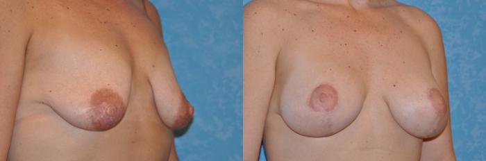 Before & After Breast Lift With Implants Case 220 View #3 View in Toledo, Ohio