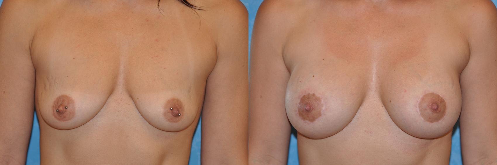 Before & After Breast Lift With Implants Case 235 View #1 View in Toledo, Ohio