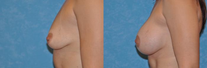 Before & After Breast Lift With Implants Case 235 View #2 View in Toledo, Ohio