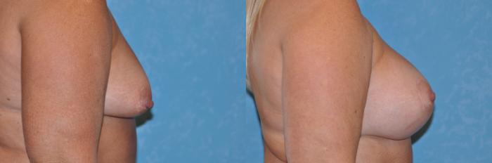 Before & After Breast Lift With Implants Case 253 View #2 View in Toledo, Ohio