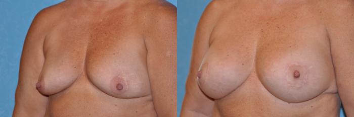 Before & After Breast Lift With Implants Case 253 View #3 View in Toledo, Ohio