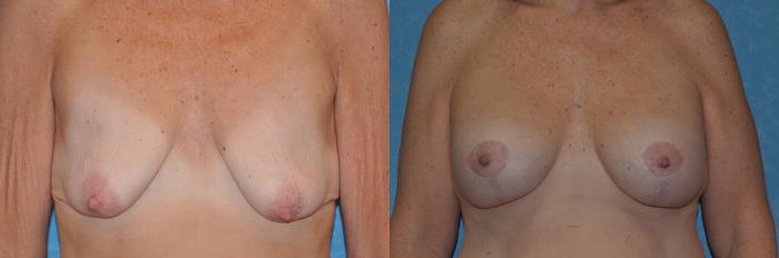 Before & After Breast Lift With Implants Case 272 View #1 View in Toledo, Ohio