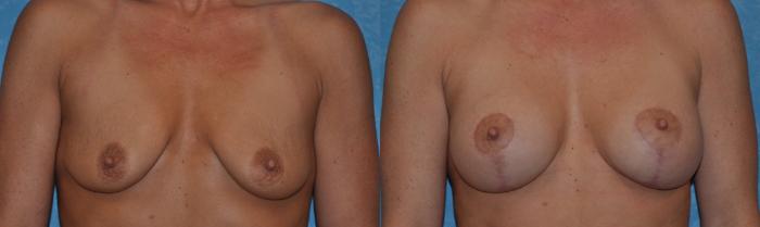 Before & After Breast Lift With Implants Case 301 View #1 View in Toledo, Ohio
