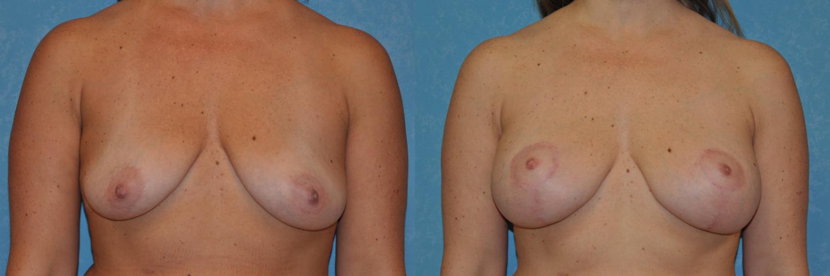 Before & After Breast Lift With Implants Case 338 View #1 View in Toledo, Ohio