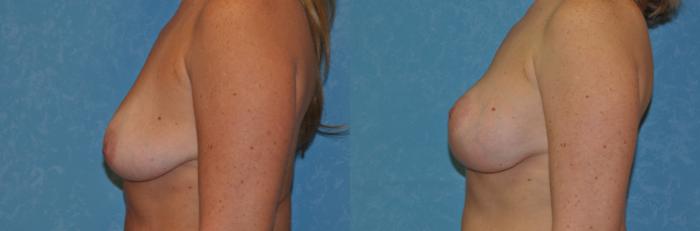 Before & After Breast Lift With Implants Case 338 View #3 View in Toledo, Ohio