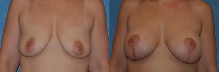 Before & After Breast Lift With Implants Case 344 View #1 View in Toledo, Ohio