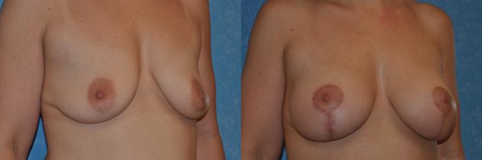 Before & After Breast Lift With Implants Case 344 View #2 View in Toledo, Ohio